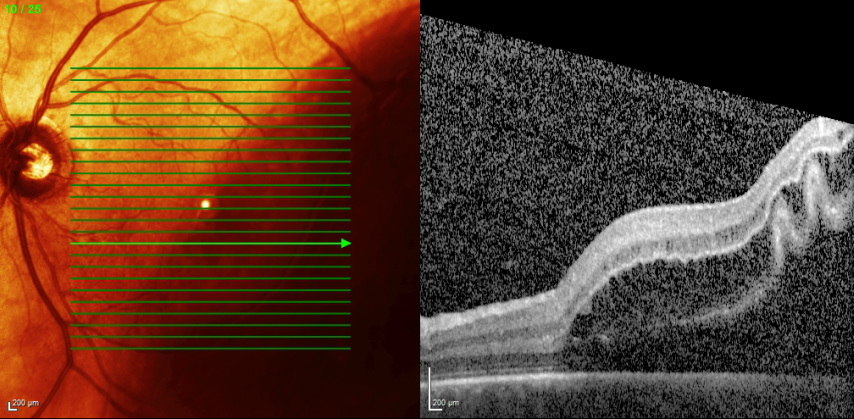 Retinal Detachment - Dr Mark Donaldson